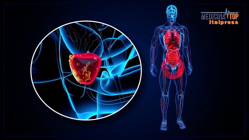 Tumore della prostata: in Italia registrati 40.000 nuovi casi all'anno