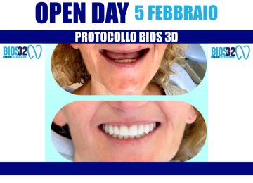 Torna giovedì 5 febbraio l'open day con Bios32: denti fissi in sole 24 ore!