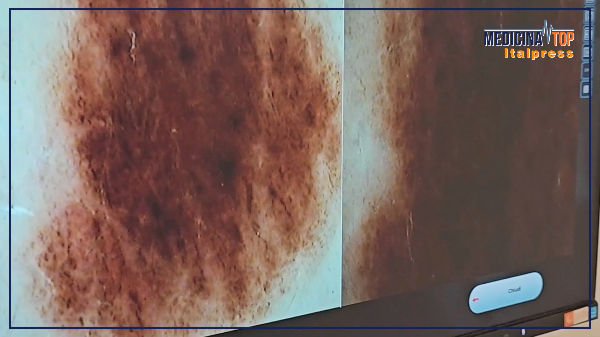 Aumento costante dei tumori cutanei non melanoma in Italia: ecco le ragioni.