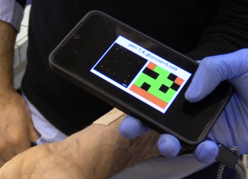 Minuscoli aghi sottopelle trasformati in QR code: la ricerca di UniPi