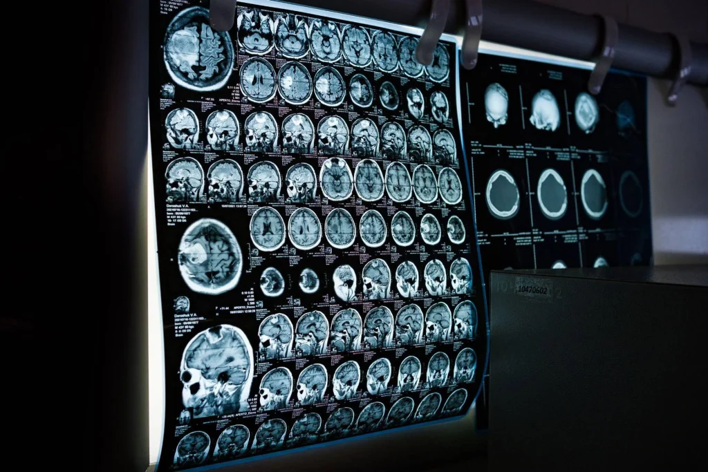 Uno spray mantiene il cervello giovane e migliora la memoria: un rivoluzionario studio