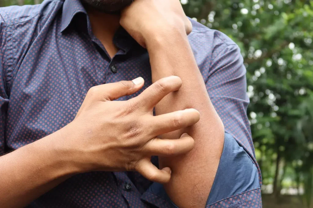 Studio Novartis: Il costo annuale per paziente affetto da orticaria cronica spontanea è di 4.200 euro