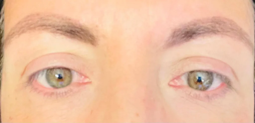 Visione offuscata o distorta: sintomo di retinopatia. Colpisce il 30% dei diabetici, la prevenzione è l'arma più efficace.