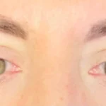 Visione offuscata o distorta: sintomo di retinopatia. Colpisce il 30% dei diabetici, la prevenzione è l'arma più efficace.